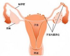 微创联合用药两期疗 微创治疗子宫内膜异位症