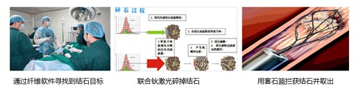 取石步骤