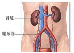 输尿管结石治疗