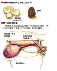 尿结石可以手术吗